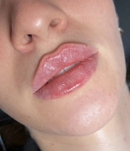 Lip Filler 