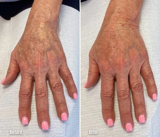 Hand Rejuvenation