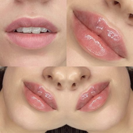 lip fillers